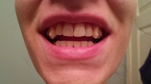One year with Invisalign